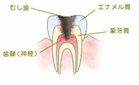 C3:歯髄まで進行した虫歯