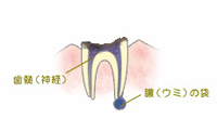 C4:歯根まで到達した虫歯