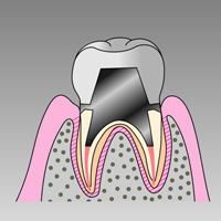 重度の虫歯治療　根管治療