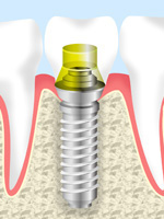 インプラントとは